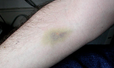 bruised